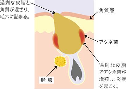 ニキビができる仕組み